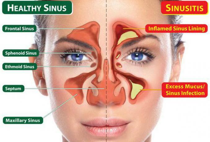 preparation sinupret at sinusitis reviews