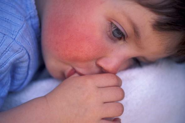 Red spot on the child