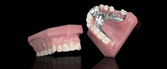 Clasp denture prosthetic: description, features, reviews