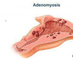 adenomyosis of the uterus treatment of folk remedies