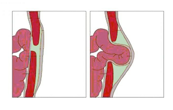 conspirația herniei ombilicale