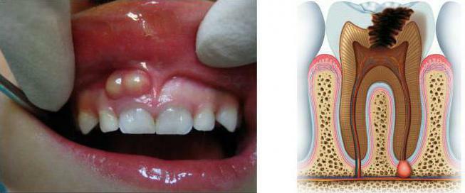 akut apikal periodontitis tedavisi