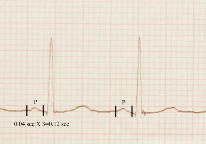 EKG dişleri