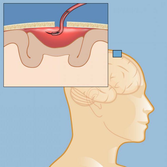 removal of hematoma intracranial