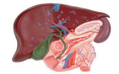 Caroli Disease