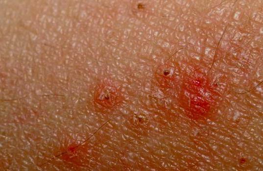 rash with allergies in children