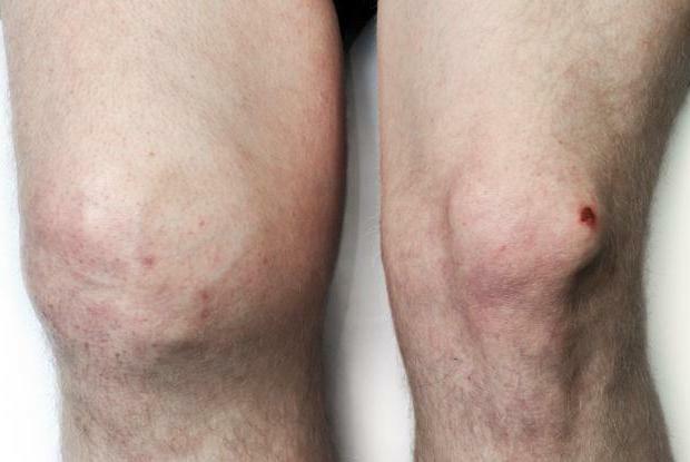 osteoarthritis of the knee joint treatment
