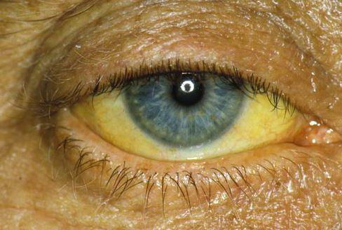 yellow eyes in human symptoms