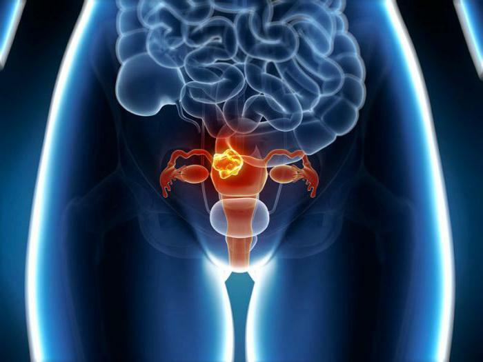 death from uterine cancer