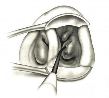 anterior rinoskopi