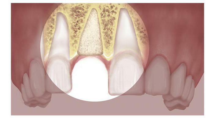 Bone plastic for dental implantation reviews