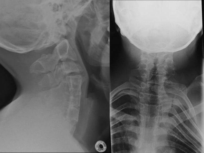 syndrome of a feil feldspot X-ray