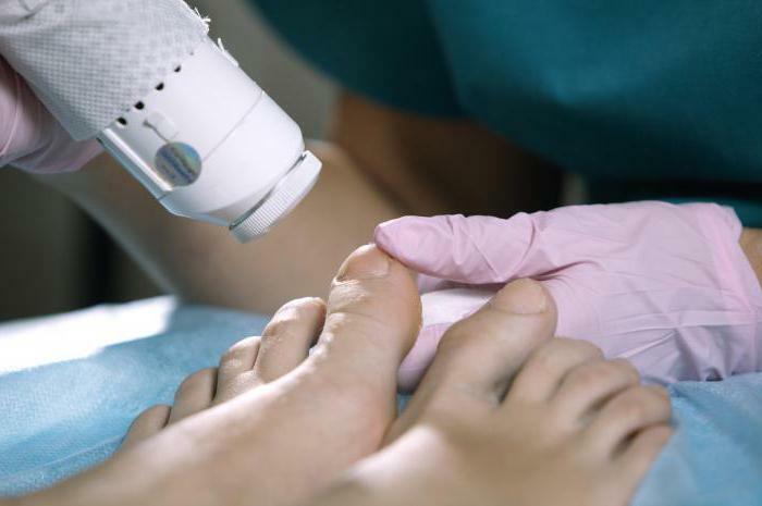 exfoliate the nail on the big toe of the cause