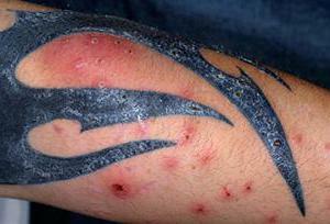 allergy to tattoo treatment