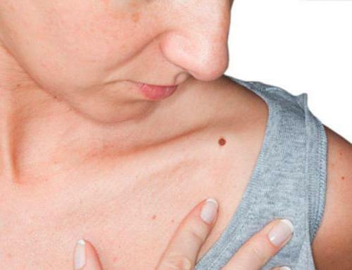 cancer moles on the body