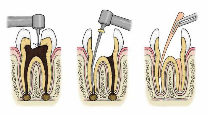 permanent root canal filling