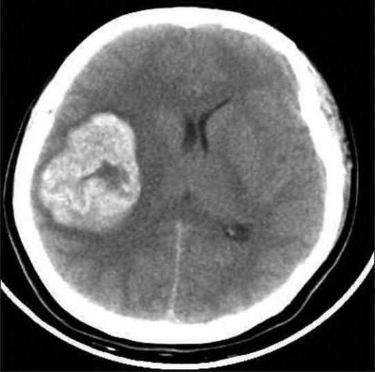 intracranial hematoma