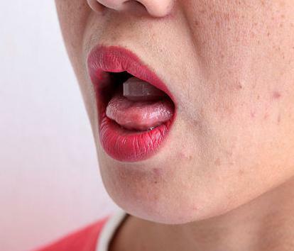 how to cure stomatitis in the tongue