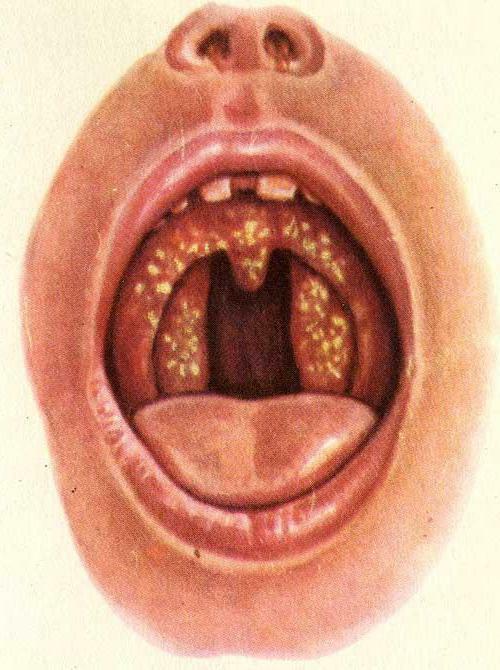 blisters on the tongue closer to the throat