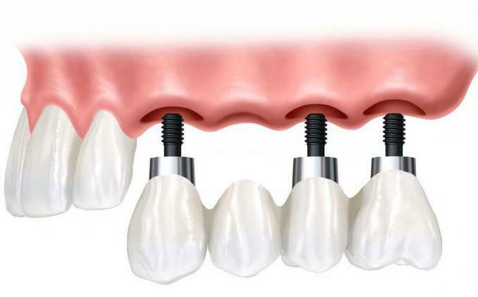 install a crown on the implant