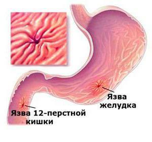 diseases of the duodenum
