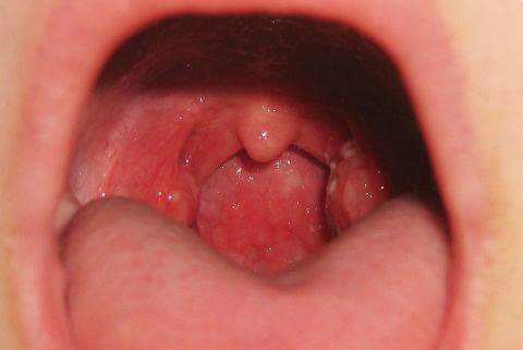 Palatine uvula photo