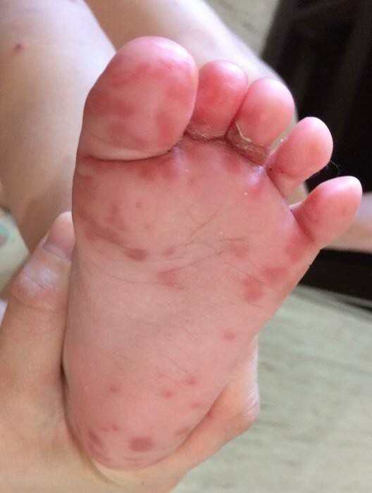 red spots on the palms and feet hurt