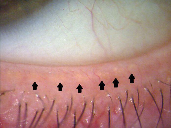 meibomian glands