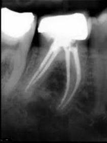 material for root canal filling