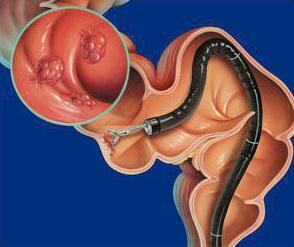 sigmoidoscopy and colonoscopy of the intestine
