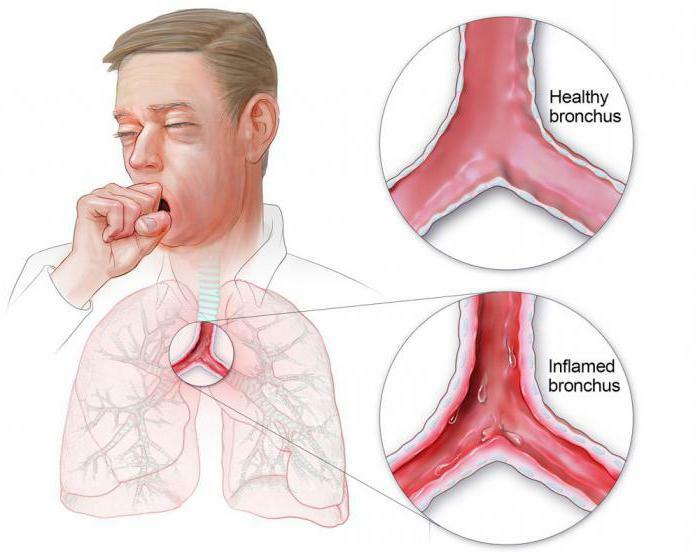 bronchitis symptoms and treatment in adults