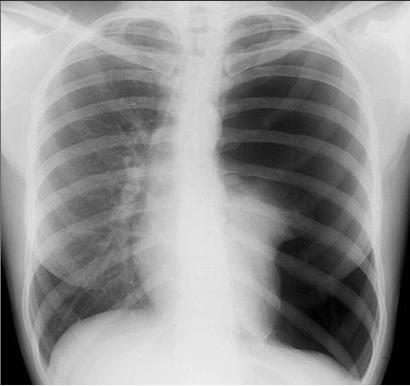 pneumothorax its kinds of physiology