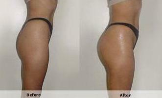 Enlargement of buttocks before and after photos