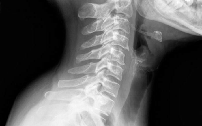 Collar of Shantz with cervical osteochondrosis: reviews( photos)