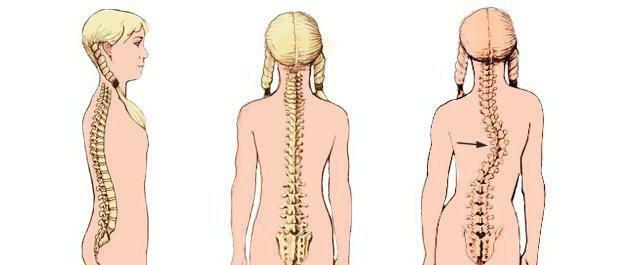 bedrovej skolióze
