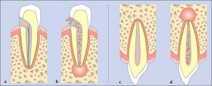 akut apikal periodontitis