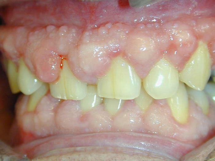 Gum fibromatosis