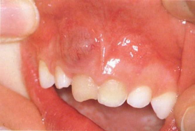 Is it possible to cure a tooth cyst without removal?