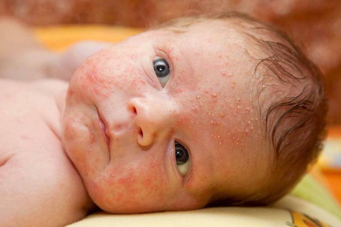 Rashes in the child