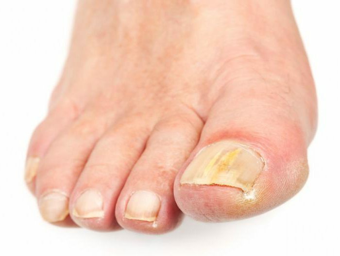 Diagnosis of fingernails and toenails