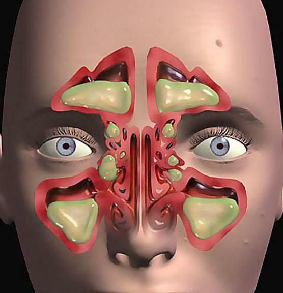 operation of maxillary sinusitis