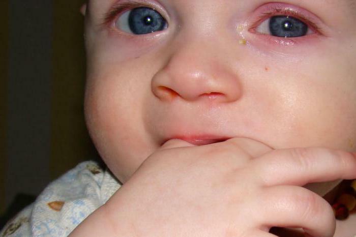 Antiviral eye drops for children
