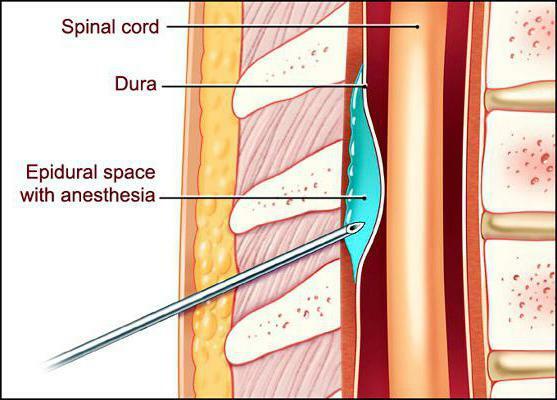 Peridural and epidural anesthesia is the difference