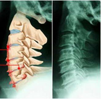 gimnastica pentru osteocondroza coloanei vertebrale lombare