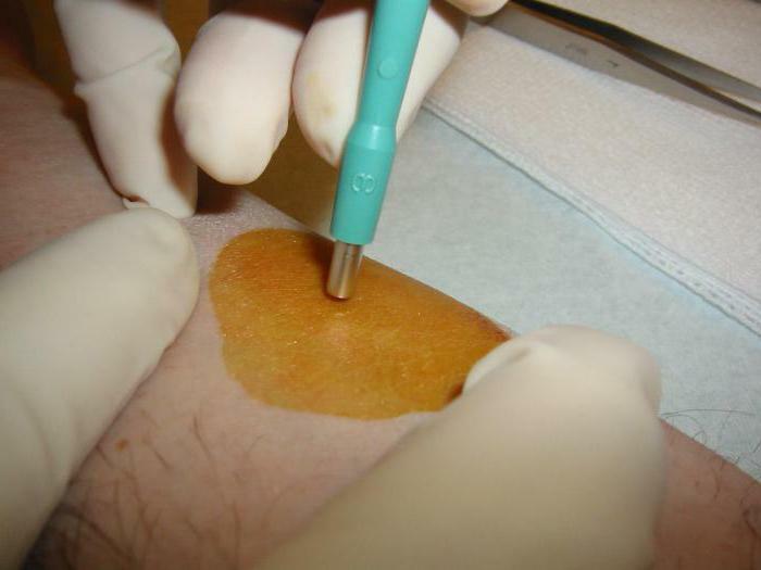 biopsja skóry z łuszczycą