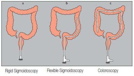 sigmoidoscopy and colonoscopy differences