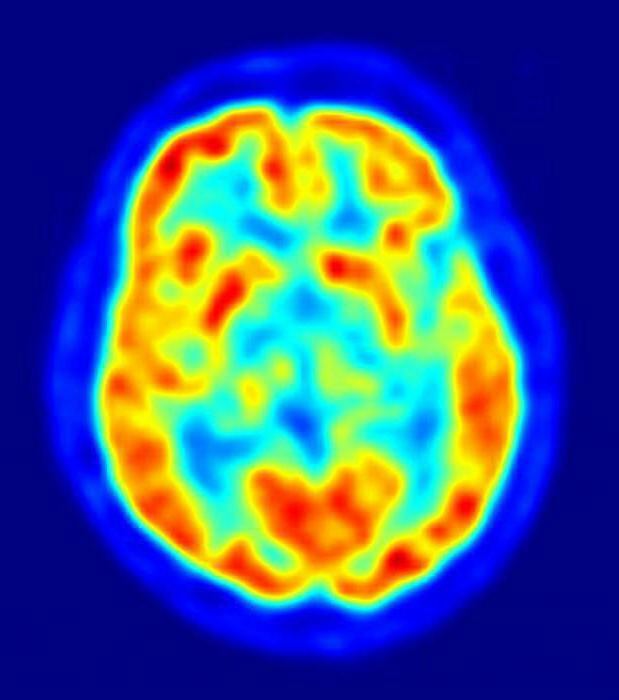 patients with Alzheimer