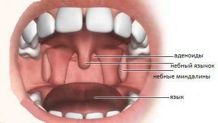inflammation of the tonsils in a child