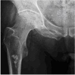 endochondroma of the thigh bone