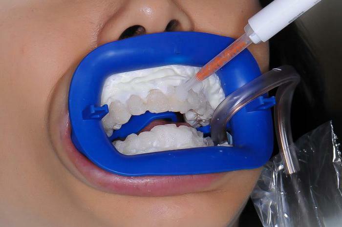 the newest methods of teeth whitening